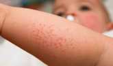 مع انخفاض درجات الحرارة.. أبرز أسباب الطفح الجلدي عند الأطفال