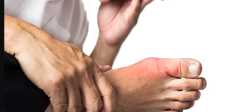 مرض النقرس
