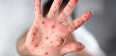 فيروس جدري القرود