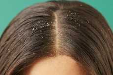 أخطاء تزيد مشكلة قشرة الشعر في الصيف