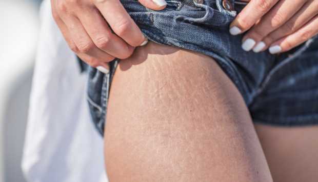 وداعًا للسيلوليت.. 5 وصفات طبيعية لبشرة مشدودة وناعمة 