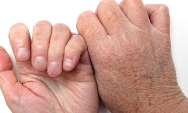 جفاف الجلد