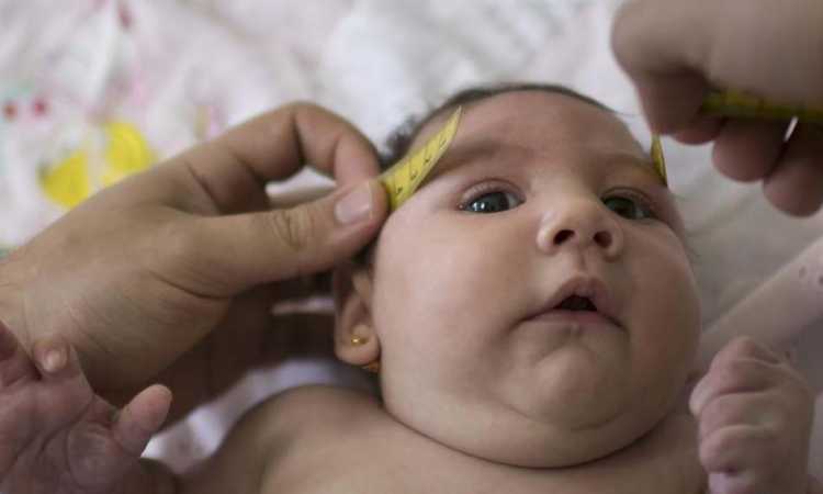 طفلة مصابة بفيروس زيكا 