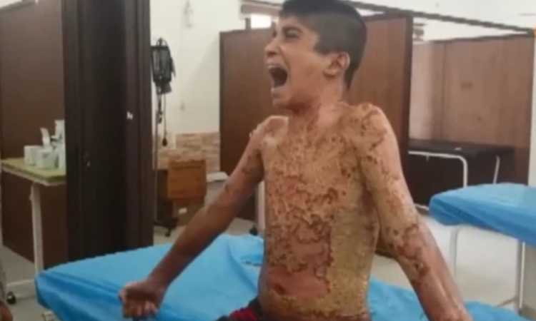 أردوغان يقصف أطفال سوريا بالكيميائى