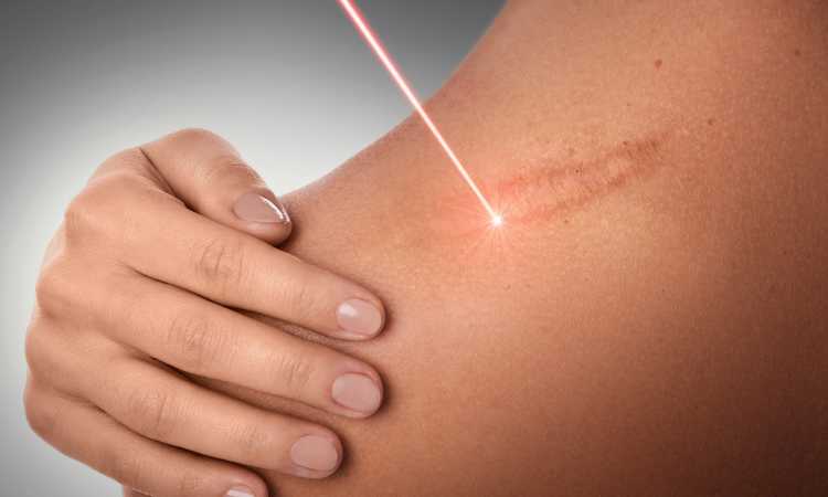 علاج الندبات