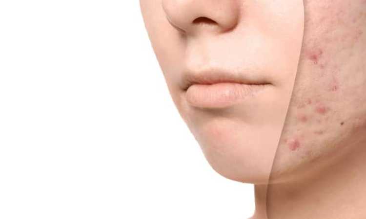 علاج ندبات الوجه ، تعبيرية