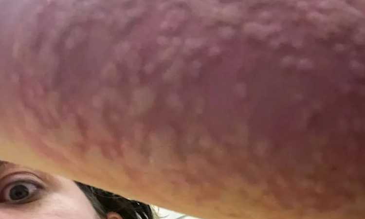لدغات البعوض