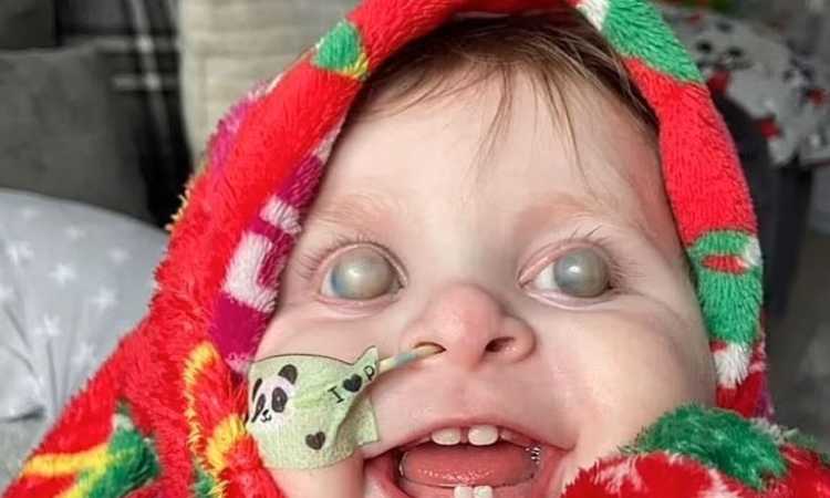 ولادة طفل بعيون منتفخة