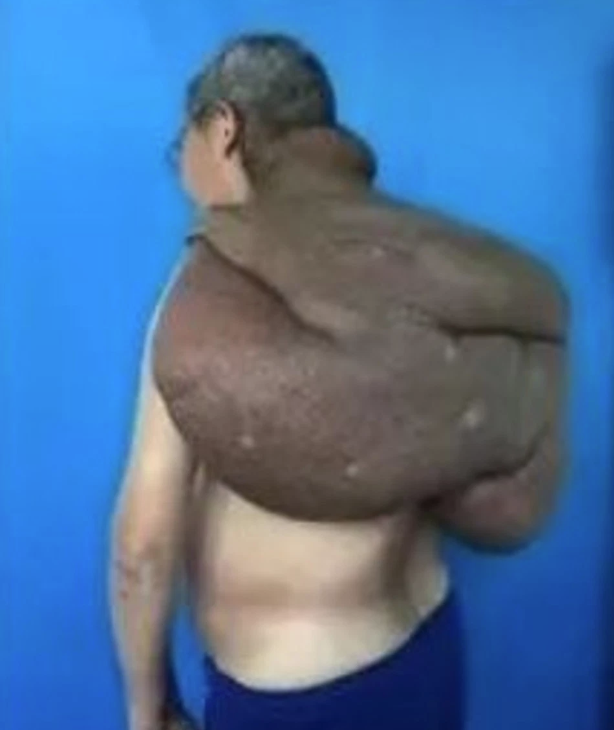 مريض صينى يتخلص من ورم يزن 28 كيلوا جرام