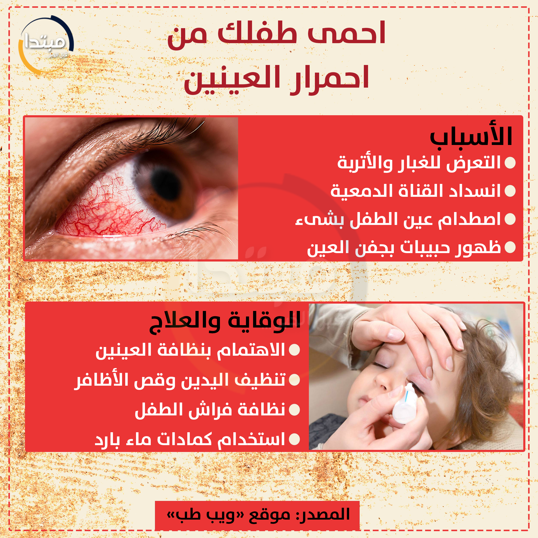 احمرار عين الطفل