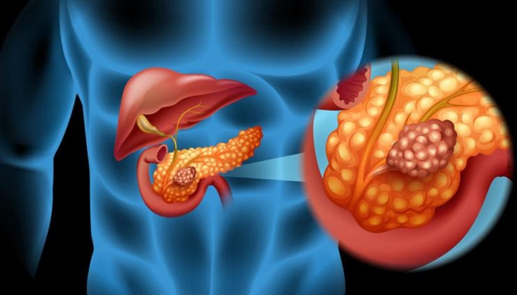 السرطان