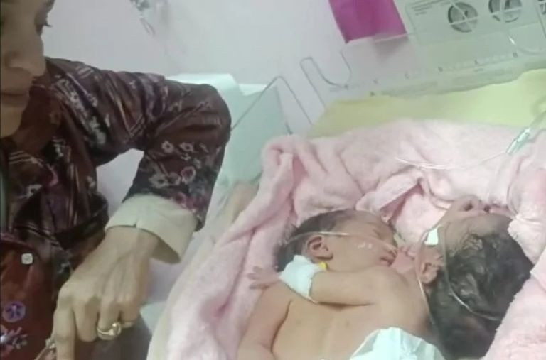 ولادة توأم بلقب واحد