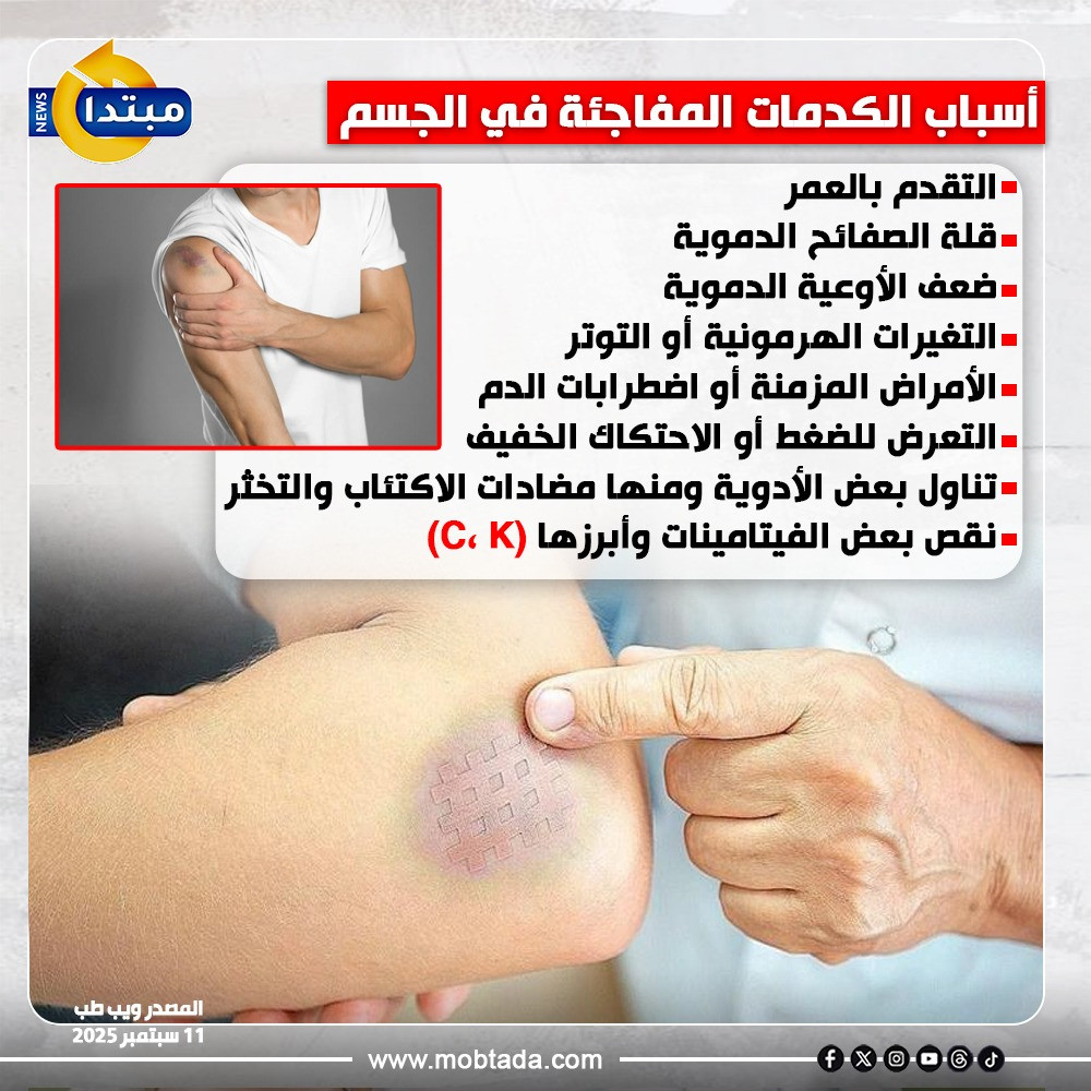 الكدمات
