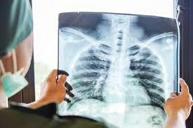 ماليزيا ترصد 10 بؤر جديدة لمرض السل في 7 ولايات وتعلن حالة تأهب صحي