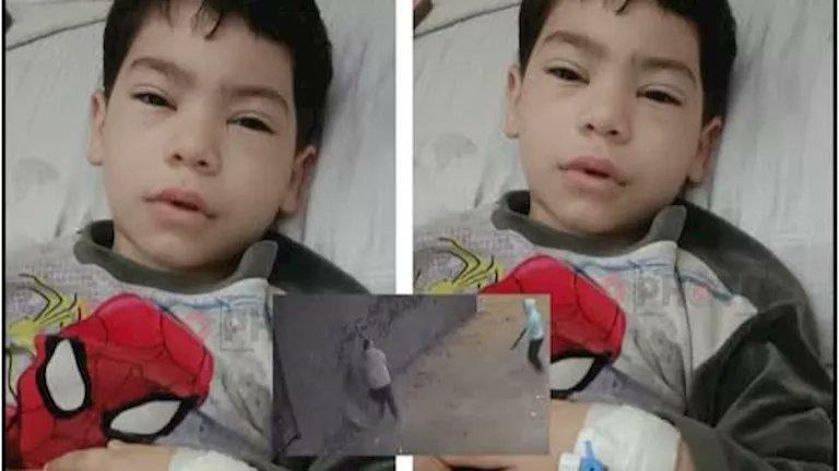 نجاح جراحة معقدة بمعهد ناصر لإنقاذ ساق طفل بعد حادث مروع