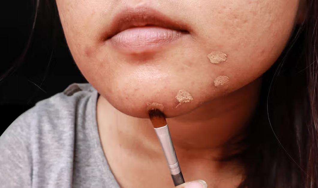 كيفية التخلص من النمش والبقع الداكنة: 3 خطوات فعالة وسريعة